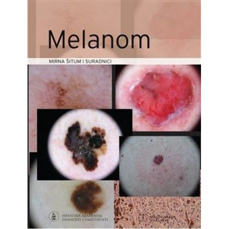 MELANOM