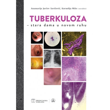 TUBERKULOZA